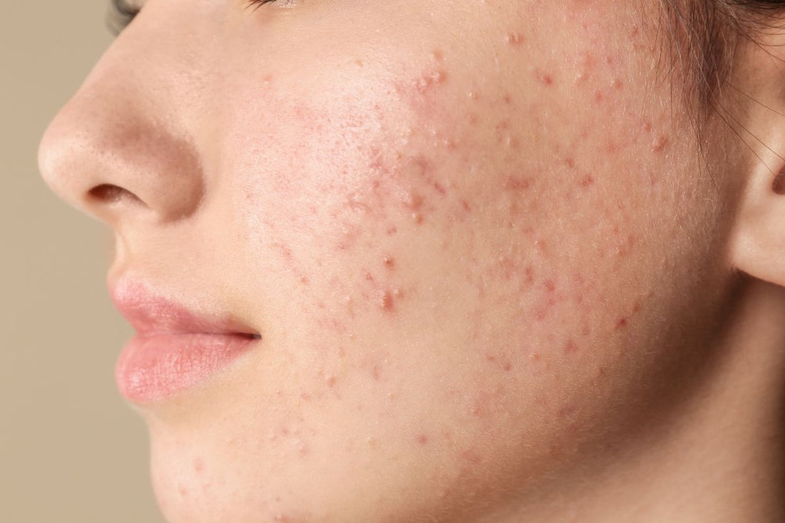 Close-up of acne-prone skin showing inflammation linked to gut imbalance and poor diet